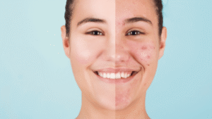 How to Get Rid of Acne Scars