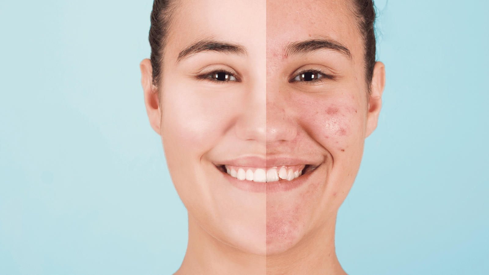 How to Get Rid of Acne Scars