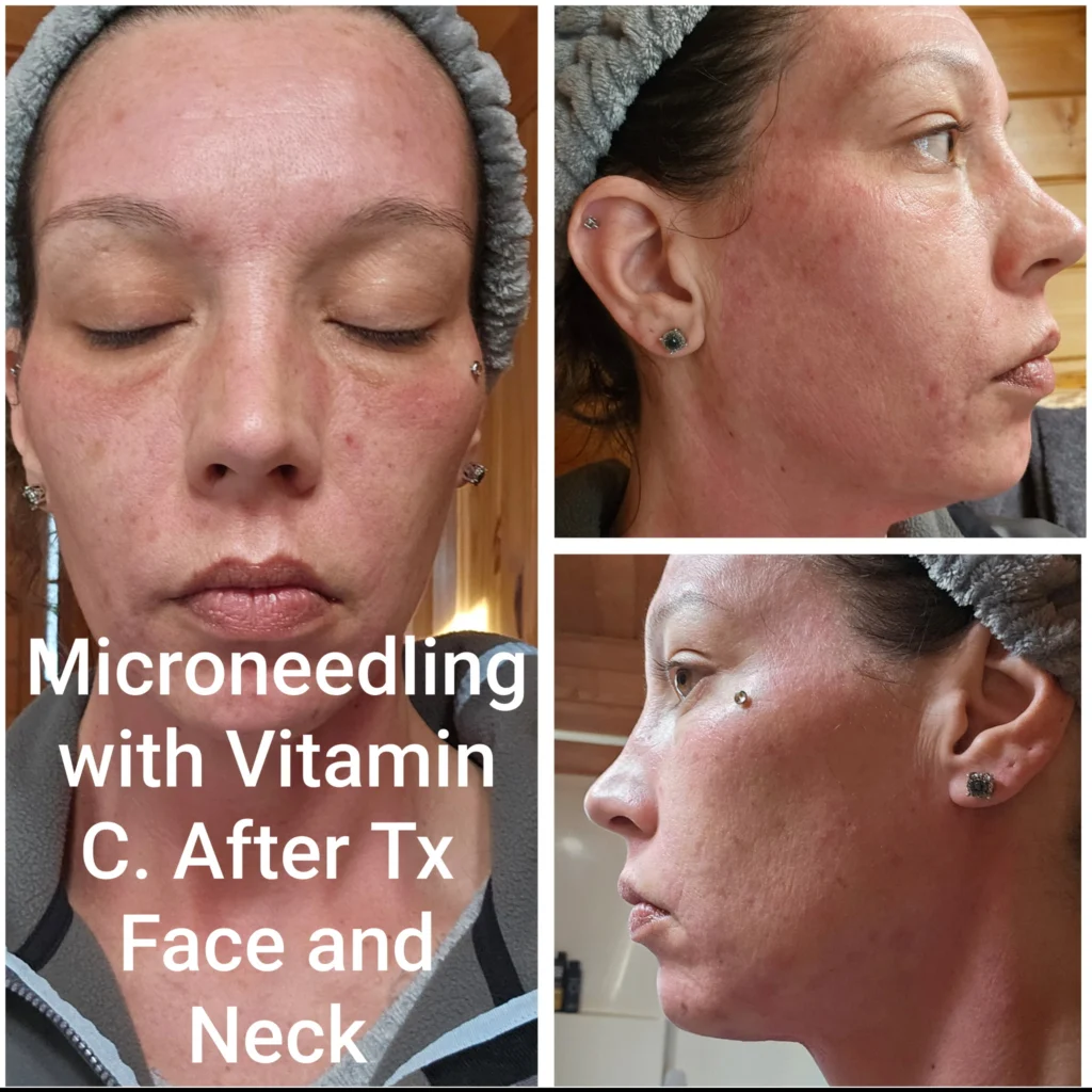microneedling before and after results