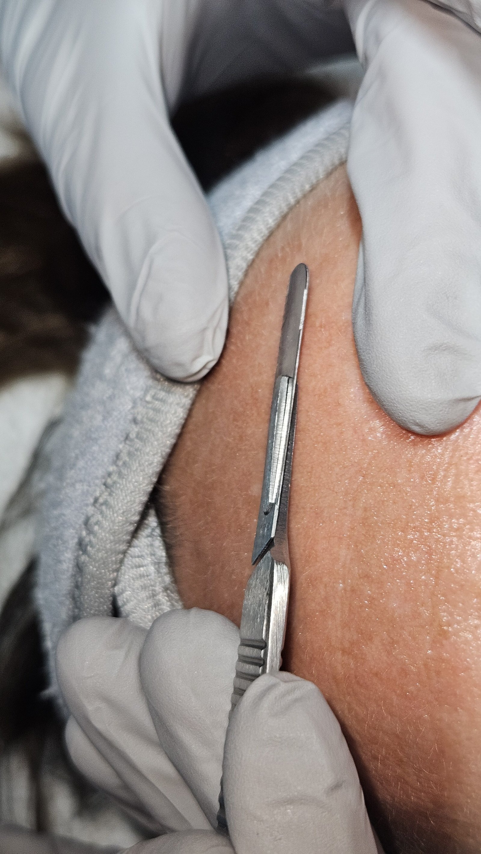 Dermaplaning in Hayward, WI