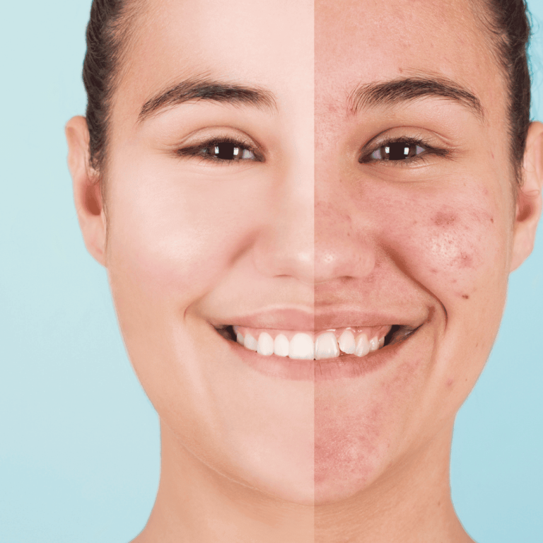 How to Get Rid of Acne Scars